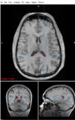 <p>lateral ventricles</p>