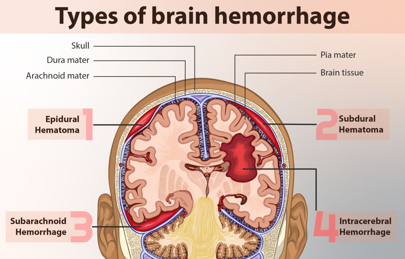 <ul><li><p><span><strong>Intracerebral Hemorrhage:</strong> Bleeding directly inside the brain tissue itself.</span></p></li><li><p><span><strong>Subarachnoid Hemorrhage:</strong> Bleeding in the area between the brain and the tissues covering it (the subarachnoid space).</span></p></li><li><p><span><strong>Subdural Hemorrhage:</strong> Bleeding that pools between the brain and the outermost layer of tissue (the dura mater).</span></p></li><li><p><span><strong>Epidural Hemorrhage:</strong> Bleeding that occurs between the skull bone and the dura mater.</span></p></li></ul><p></p>