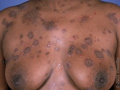<p>+ Nikolsky sign </p><p>+ Mucosal involvment</p>