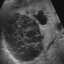 <p>PT is asymptomatic, what is the dx and describe the sonography</p>