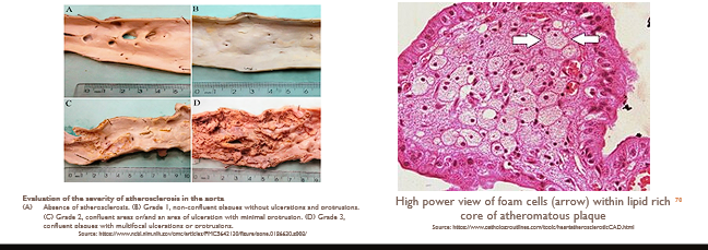 <ul><li><p><strong>Mechanism:</strong> <span style="font-family: "Gill Sans MT"; color: red;"><strong>Hypercholesterolemia</strong></span><span style="font-family: "Gill Sans MT";"><strong>;</strong> elevated blood cholesterol levels lead to disruption in cellular function, oxidative stress, inflammation</span></p></li><li><p><span style="font-family: "Gill Sans MT";"><strong>Organs affected: </strong>blood vessels (atherosclerosis)</span></p></li><li><p><span style="font-family: "Gill Sans MT";"><strong>Gross morphology: </strong> yellow discoloration of an organ</span></p></li></ul><ul><li><p><span style="font-family: "Gill Sans MT";"><strong>Microscopic morphology: </strong>foam cells (lipid-laden macrophages)</span></p></li></ul><p></p>