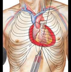 <p>Which of the following is false? Rupture of a severe myocardial infarction could result in</p>