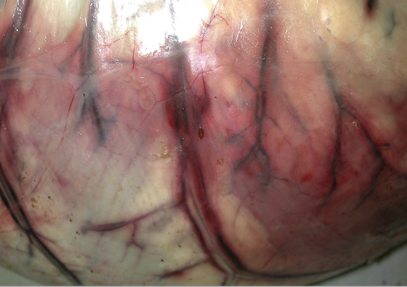 <p>non lesion or pathology </p>