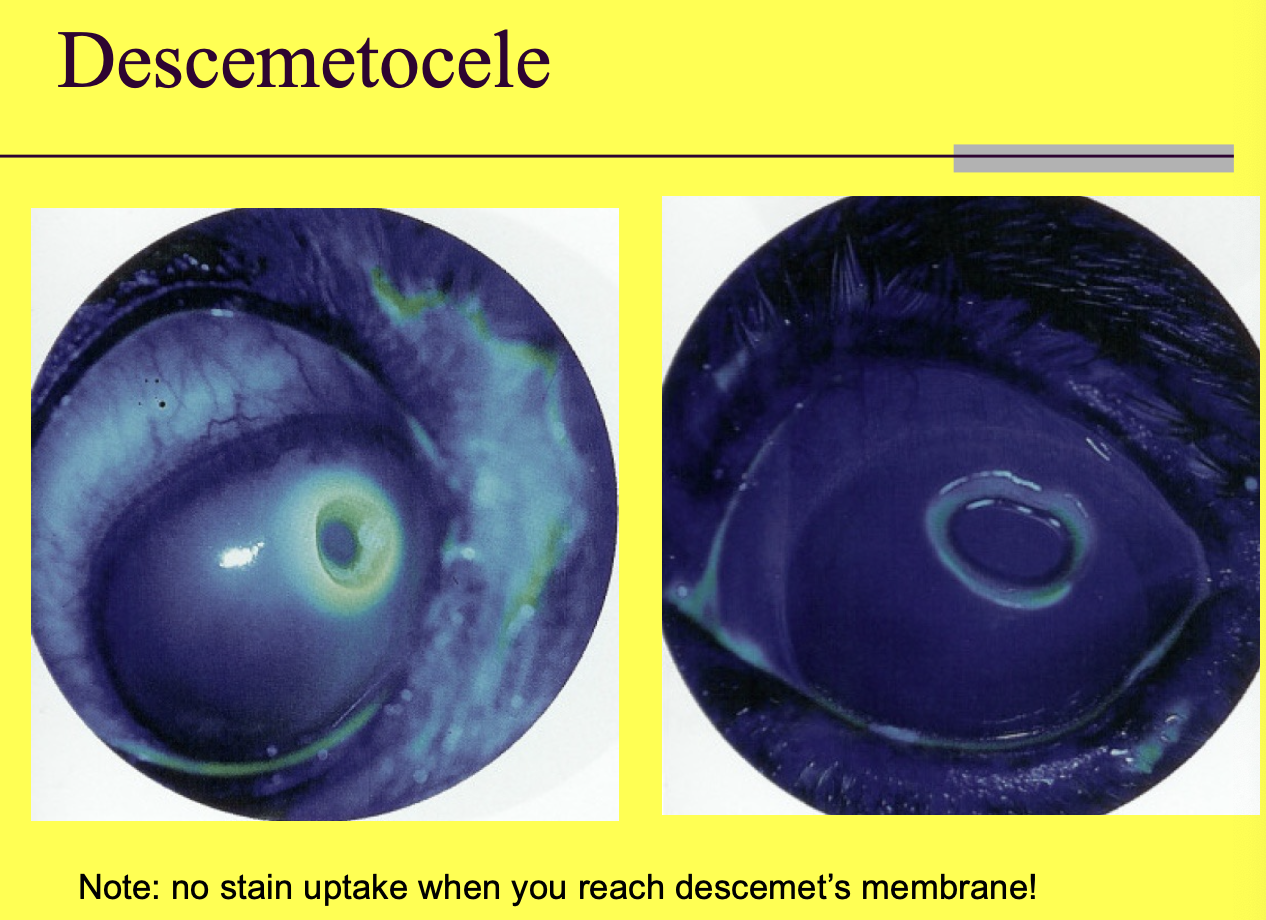 <p>Will stain the surrounding stroma but not Descemet's membrane.</p>