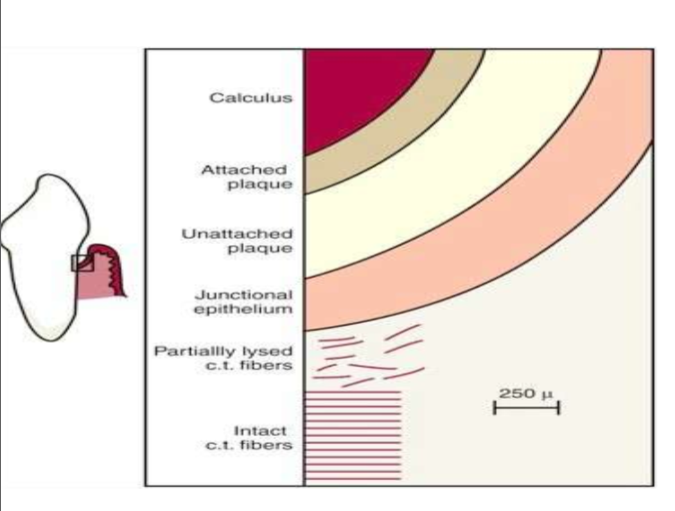 <ol><li><p>cementum covered by calc (tissue changes occuring)</p></li><li><p>attached plaque (over calc, extends apically)</p></li><li><p>unattached plaque (surrounds att. plaque and extends apically)</p></li><li><p>JE reduced attachment in disease (autoimmune)</p></li><li><p>JE attached to tooth - reduced in disease</p></li></ol><p></p>