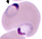 <p>when there are multiple infections in the red blood cell by Plasmodium </p>