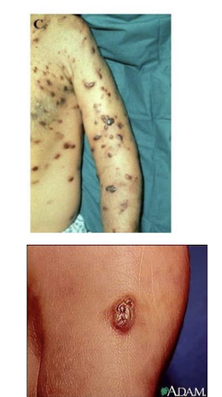 <p><strong>Kaposi's sarcoma, primary effusion lymphoma:</strong> </p><ul><li><p><strong>Form of skin cancer that can involve internal organs</strong></p></li><li><p><strong><u>Primarily affects immunocompromised individuals</u> </strong>such as those with HIV/AIDS. </p></li><li><p><strong>Seroprevalence</strong> 1-2.5% in US blood donors </p></li></ul><p></p>