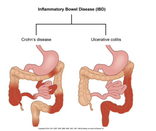 <ul><li><p><span style="background-color: transparent;">Crohn’s = you still may get some nutrition because you still have some good bowels&nbsp;</span></p><p></p></li><li><p><span style="background-color: transparent;">UC = starts at the rectum and keeps progressing upward; you don’t absorb anything from a bowel that’s inflamed. The higher that it progresses, the more problems that you’re going to have.</span></p><p></p></li><li><p><span style="background-color: transparent;">UC mainly affects the large intestines, we have to worry abt Crohn’s more with the small intestines&nbsp;&nbsp;</span></p><p><br></p></li></ul><p></p>