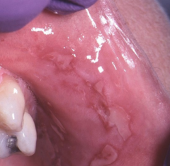 <p>Chronic autoimmune vesiculobullous disease with fragile epithelial separation.</p>