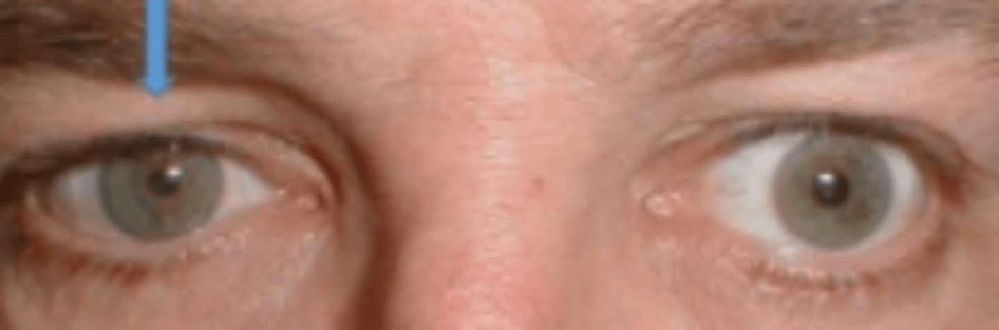 <p>Dysfunction of Mueller's muscle secondary to the disruption of the oculo-sympathetic pathway may be responsible for ____ seen in Horner's syndrome</p>