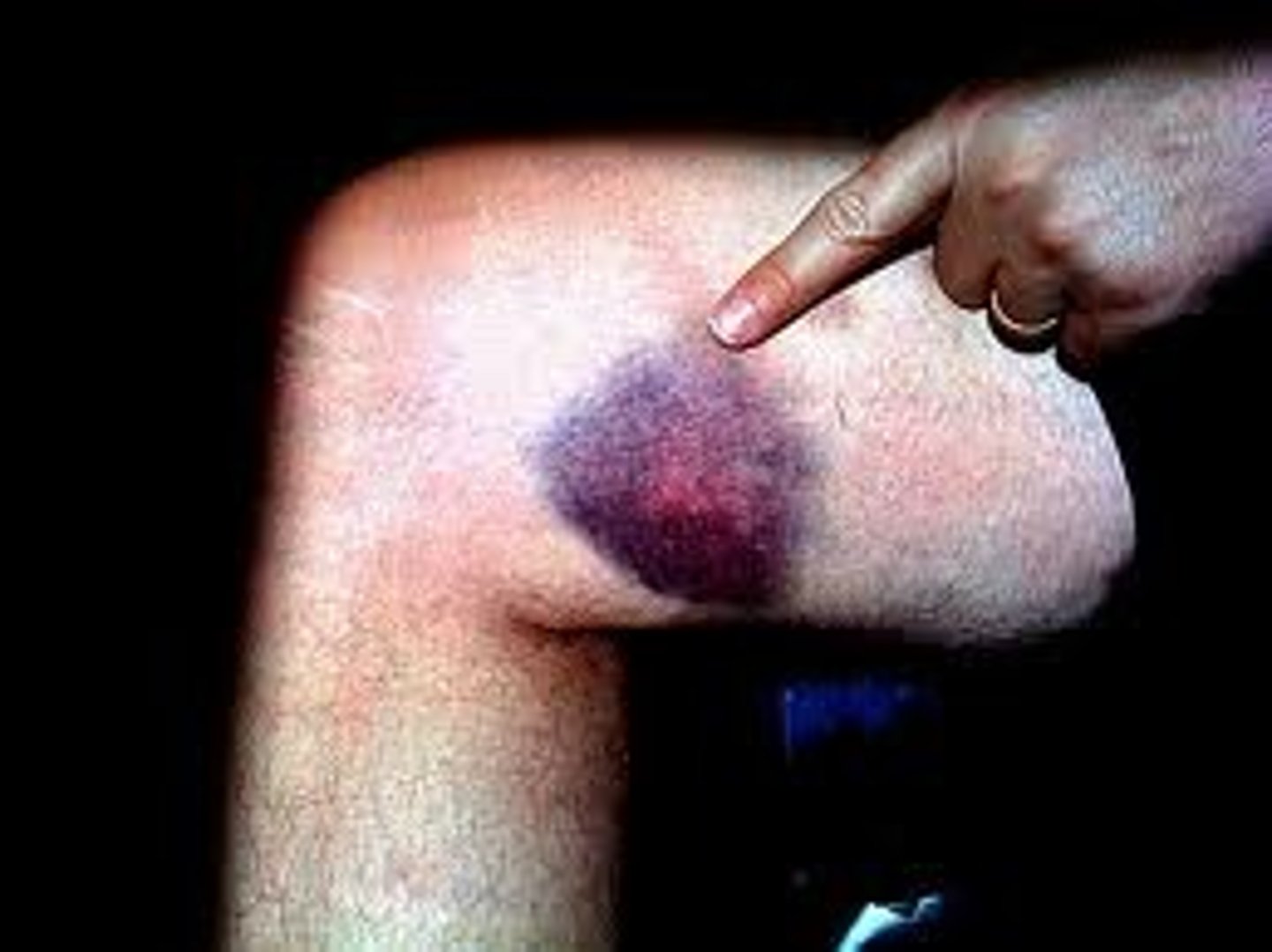 <p>vết bầm tím She got a small ___________ on her leg after bumping into the table.</p>