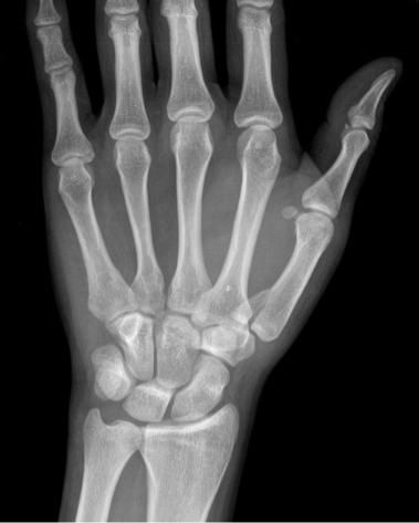 <p>What type of fracture is shown in the image?</p>
