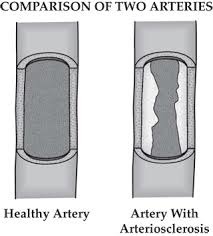 <p>Hardening of the artery</p>