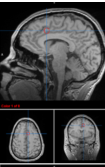 <p>medial motor cortex</p>