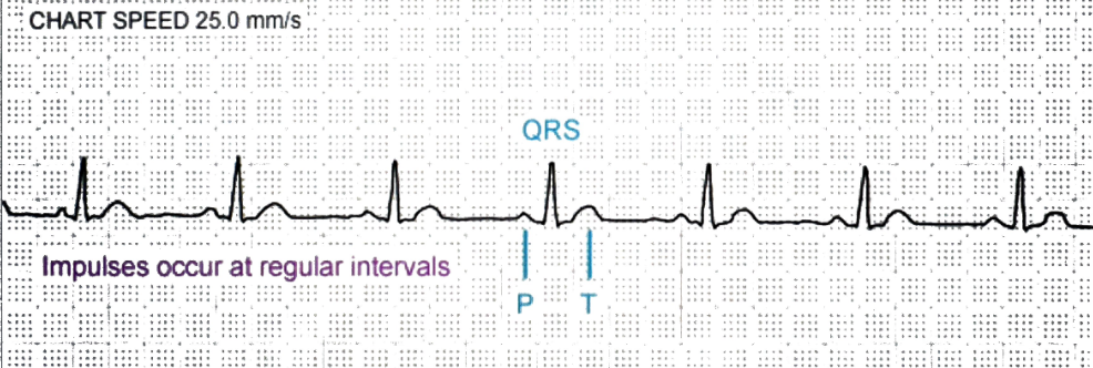 <p>Regular rhythm, 60–100 bpm, normal P before every QRS</p>