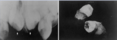 <p>-larger than conical tooth</p><p>-has more than 1 cusp</p><p>-barrel-shaped</p><p>-stunted root formation</p><p>-often paired in two </p><p>-on the palatal aspect of maxillary central incisors</p>