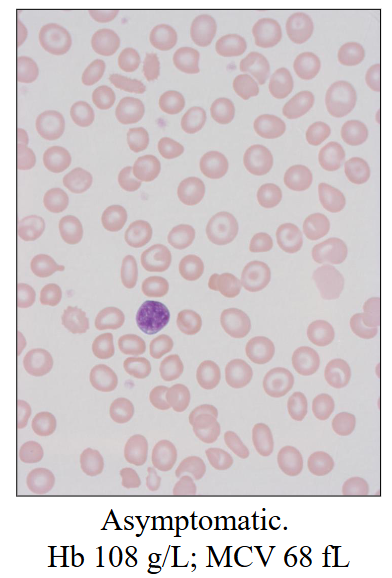 <p>- Usually B B+ - thalassaemia</p><p>- Borderline anaemia</p><p>- Microcytic red cells</p><p>- usually asymptomatic</p><p>- PB film: unremarkable or mild poikilocytosis</p><p>- Elevated HbA2</p><p>- Borderline elevated HbF</p>