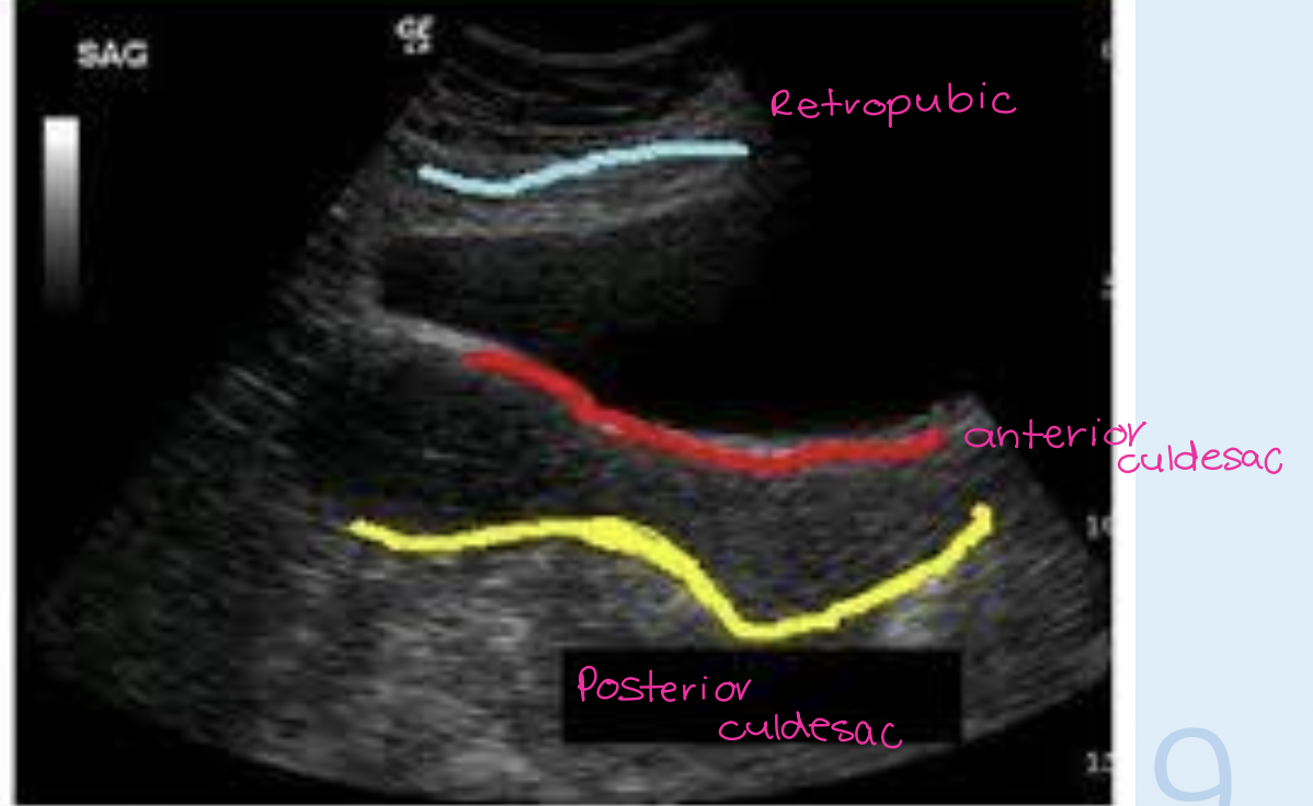 <ul><li><p>anterior cul-de-sac</p></li><li><p>anterior to fundus between the bladder &amp; uterus</p></li></ul><p></p>