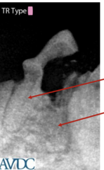 <p>what type of tooth resorption is this?</p>