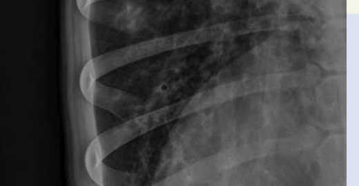 <p>Bronchial pattern</p><ul><li><p>have donut or ring</p></li></ul><p></p>