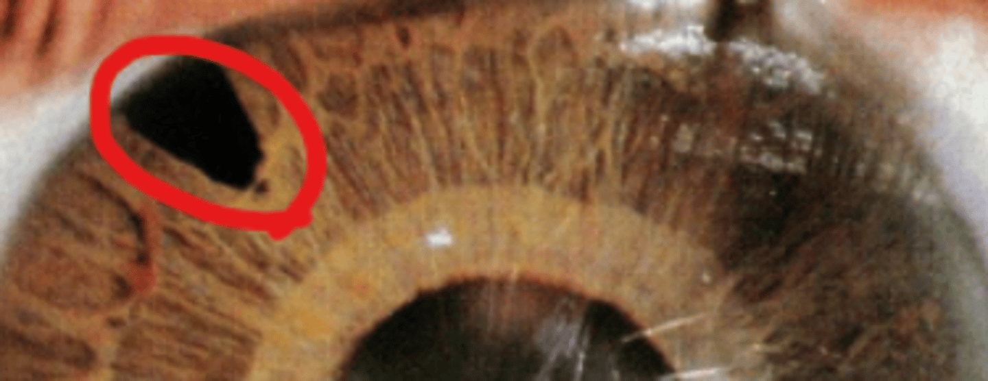 <p>surgical removal of a portion of the iris at its root leaving the pupillary margin and sphincter muscle intact. Is indicated when laser treatment cannot be accomplished or is no effective.</p>