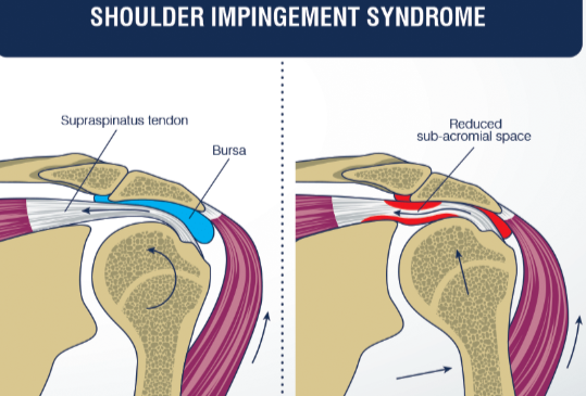<p><span style="background-color: transparent;">this is when the tendons of <strong>the rotator cuff</strong> (supraspinatus, infraspinatus, subscapularis, and teres minor) or the <strong>subacromial bursa</strong> <strong>get pinched</strong> and compressed <strong>between the</strong> head of the <strong>humerus</strong> <strong>and</strong> the <strong>acromion</strong> during arm movement</span></p><p><span style="background-color: transparent;">if they are already irritated and swollen it can get even worse</span></p><p><span style="background-color: transparent;">especially <strong>supraspinatus</strong> tendon</span></p>