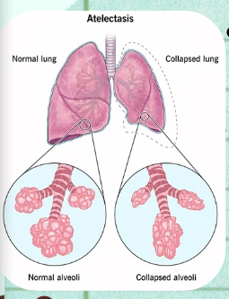 <p><span>Incomplete expansion of alveoli, typically describing the lungs.</span></p>