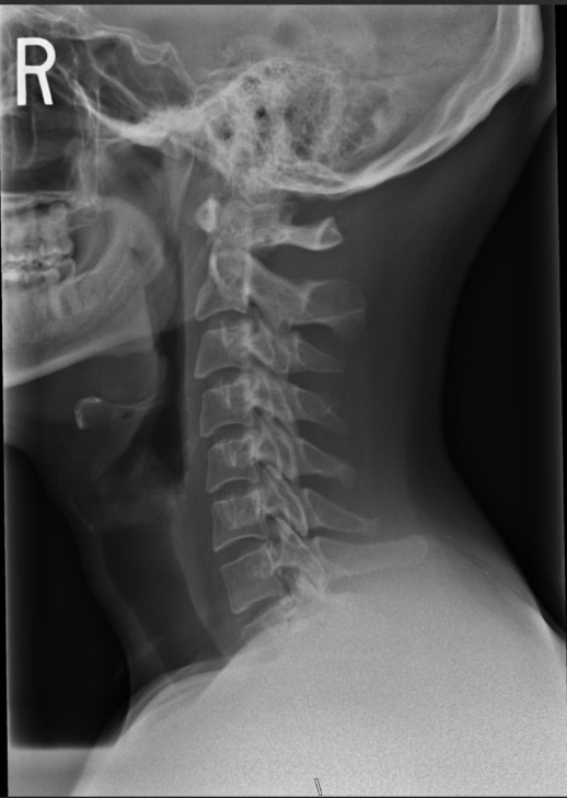 <p>Is this film of diagnostic quality (Lateral Cervical) </p>