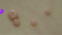 <p>benign epithelial tumors that are dome-shaped with a typical umbilicus, up to 1 cm, caused by the poxvirus</p>