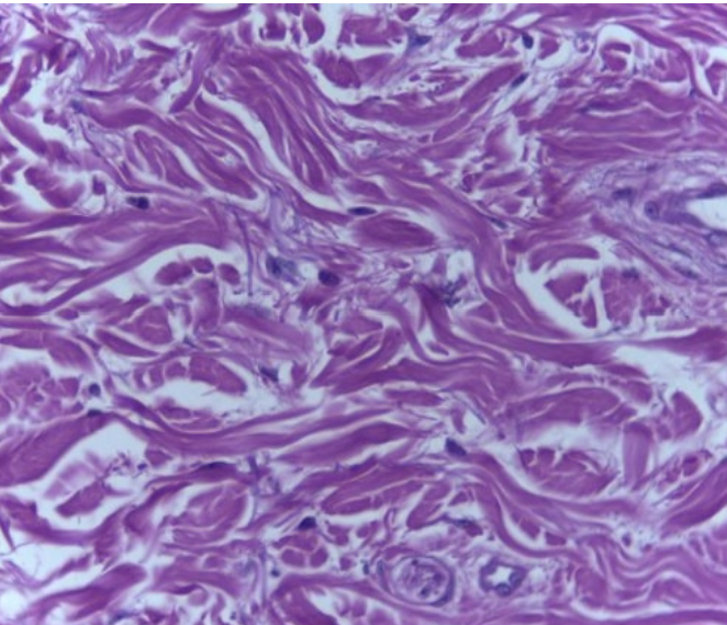 <p>Dense Irregular Connective Tissue</p>