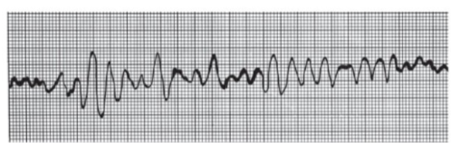 <p>chaotic, irregular EKG deflections; acute heart attack and electrical shock</p>