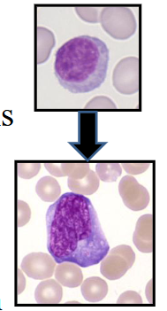 <p>Reactive: most commonly secondary to viral infections</p><p>- Lymphocytes react to the infection</p><p>- Infectious mononucleosis (EBV; glandular fever)</p><p>- Also: CMV, COVID-19, viral hepatitis, Varicella</p><p>- Altered morphology: increased size and cytoplasm</p><p>.</p><p>- Can occur secondary to bacterial infection: e.g. B. pertussis; whooping cough) in children</p><p>.</p><p>Lymphocytosis due to malignancies:</p><p>- Acute and chronic leukaemias</p><p>- Lymphoma</p>