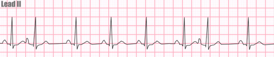 <p>Identify the arrhythmia shown on the EKG.</p>