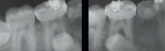 <p>Where is the impacted premolar located relative to the first molar?</p>