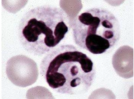 <p>what fungal infection is shown in the image?</p>