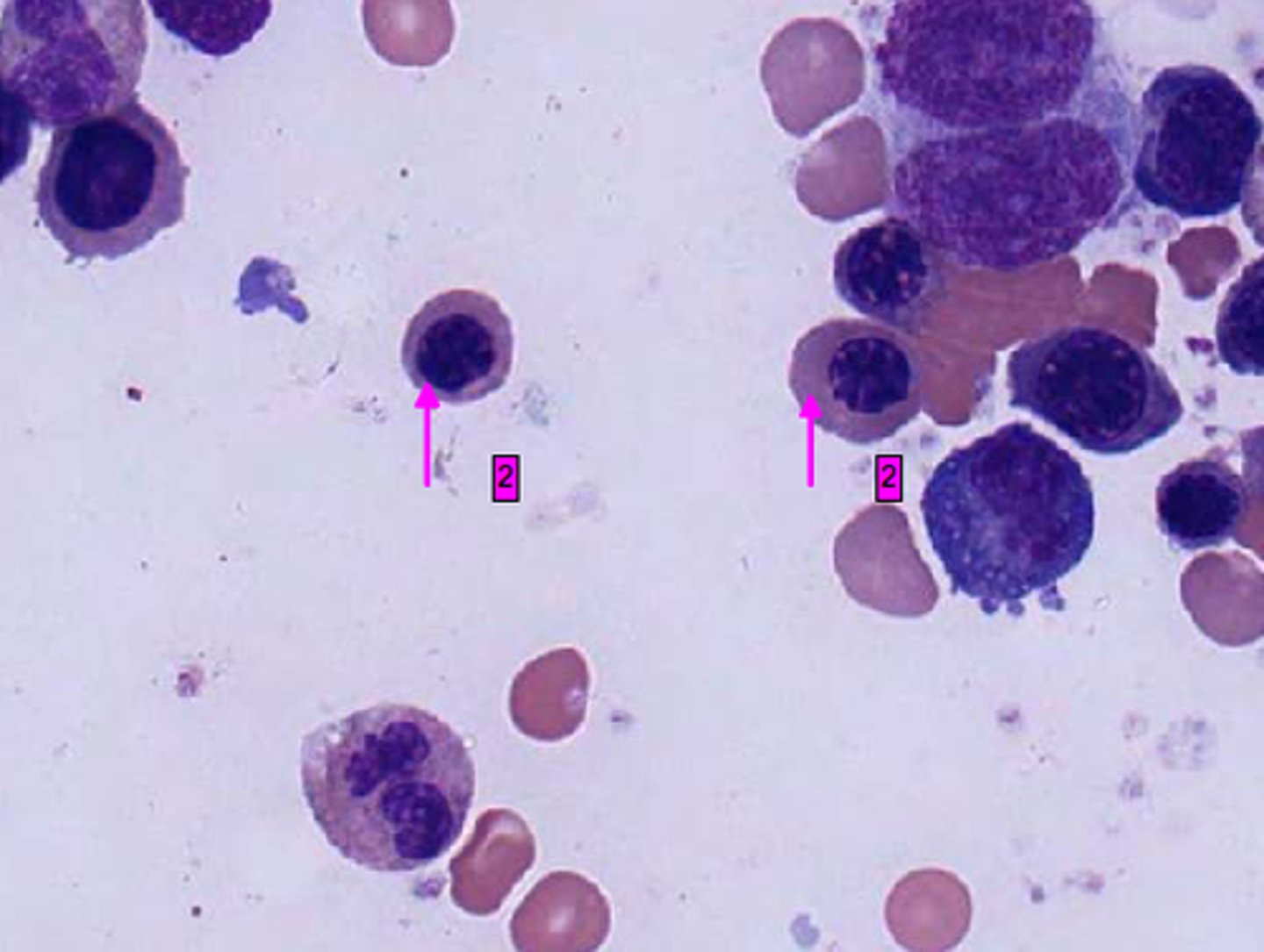 <p>mother's blood is incompatible with their infants</p>