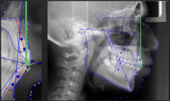<p>what distance measurement:</p><p>- Nasion-A Point to the upper incisors</p><p>- AP relationship between the cranial base, maxilla, and the upper incisors</p><p>- Measured from the incisal edge of the upper incisor to Nasion-A Point along a perpendicular line</p><p>- If U1 is anterior to NA, the measurement is positive</p><p>- If U1 is posterior to NA, the measurement is negative</p><p>- Tells you about the horizontal position of the upper incisors</p>
