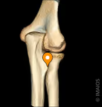 <p>What bone landmark is this within the <strong>Ulna</strong></p><ul><li><p>Medial Forarm Bone; Antebrachial, Ulnar Region)</p></li></ul><p></p>