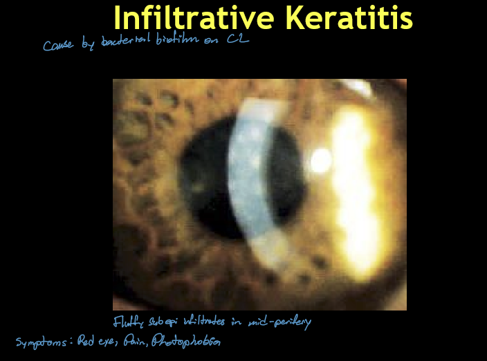 <ul><li><p>Usually unilateral</p></li><li><p>Single or few small, round, hazy subepithelial infiltrates</p></li><li><p>Location: central or mid‑peripheral cornea</p></li><li><p>Often positive fluorescein staining</p></li><li><p>Mild-moderate irritation, redness, ± discharge</p></li></ul><p></p>
