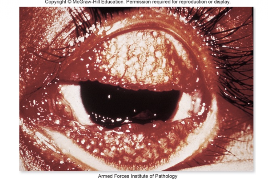 <p>Trachoma</p>