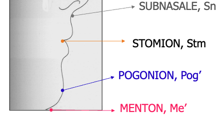 <p>Subnasale to menton</p>
