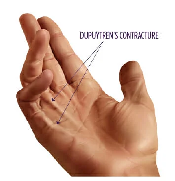 <p>What is dupuytren’s contracture?</p>