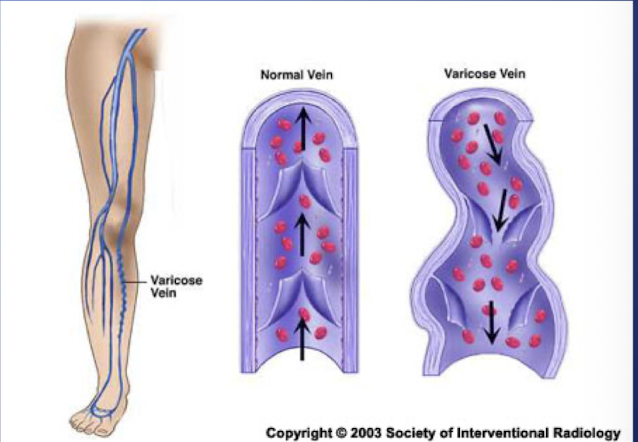 <p>-Irregular torturous veins </p><p>-Usually effects veins of lower extremities (saphenous veins)</p><p>-Caused by long standing increased venous pressure</p><p>-Veins valves become incompetent </p>