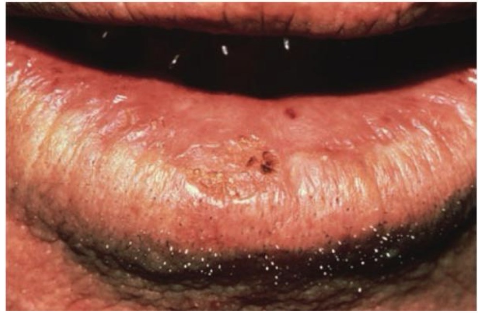 <p>BN 50y</p><p>XUẤT HIỆN TỔN THƯƠNG Ở MÔI DƯỚI</p><p>CHẨN ĐOÁN?</p>