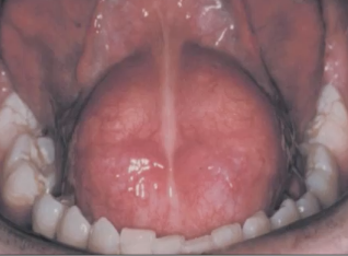 <p>FOM swelling usually in the MIDLINE</p>