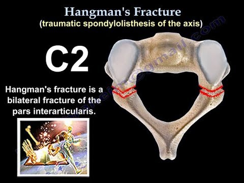 <p>Fraktura e të varurit (Hangman's fracture)</p>