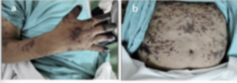 <p>El estado reaccional vascular con necrosis que se observa en esta fotografia se presenta en los pacientes portadores de:</p>