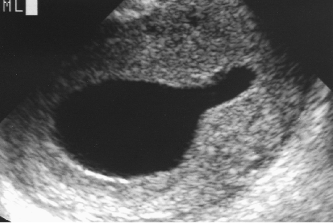 <p>What is the most likely diagnosis?</p>