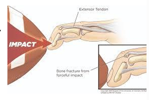 <ul><li><p>+/- Pain at dorsal DIP joint - When the bone is not involved, this lesion can be remarkably painless. </p></li><li><p>Inability to actively extend DIP with PIP stabilized in full extension</p></li></ul><p></p>