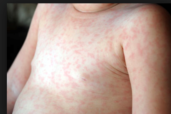 <p>Causative Agent: Human herpesvirus 6 (HHV-6) and sometimes HHV-7<br>Symptoms/Signs: Rash on chest and trunk, High fever for up to 3 days, Seizures, Becomes latent</p>